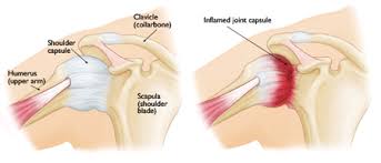 adhesive capsulitis pic