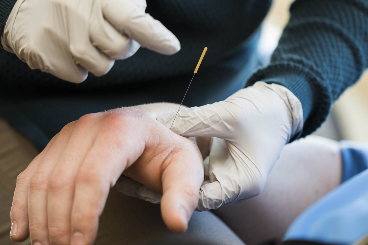 Dry Needling- What You Should Know